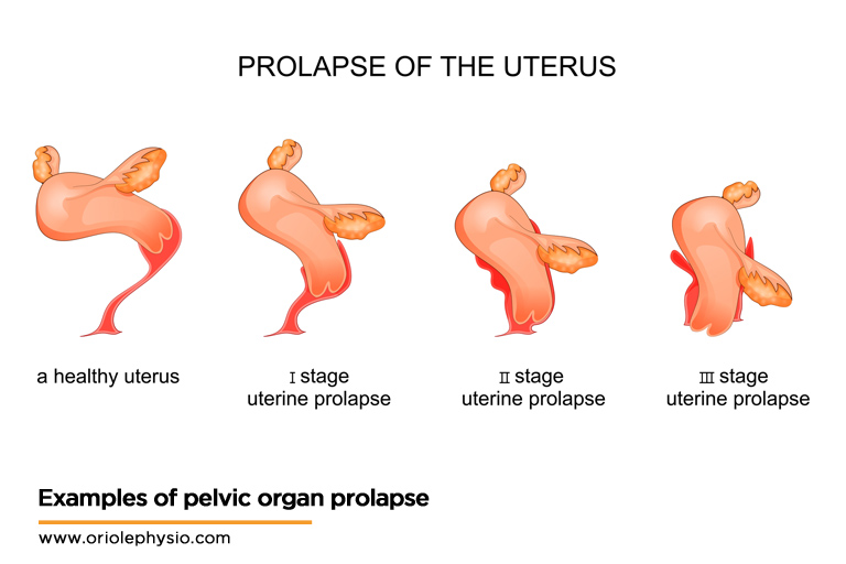 Examples-of-pelvic-organ-prolapse