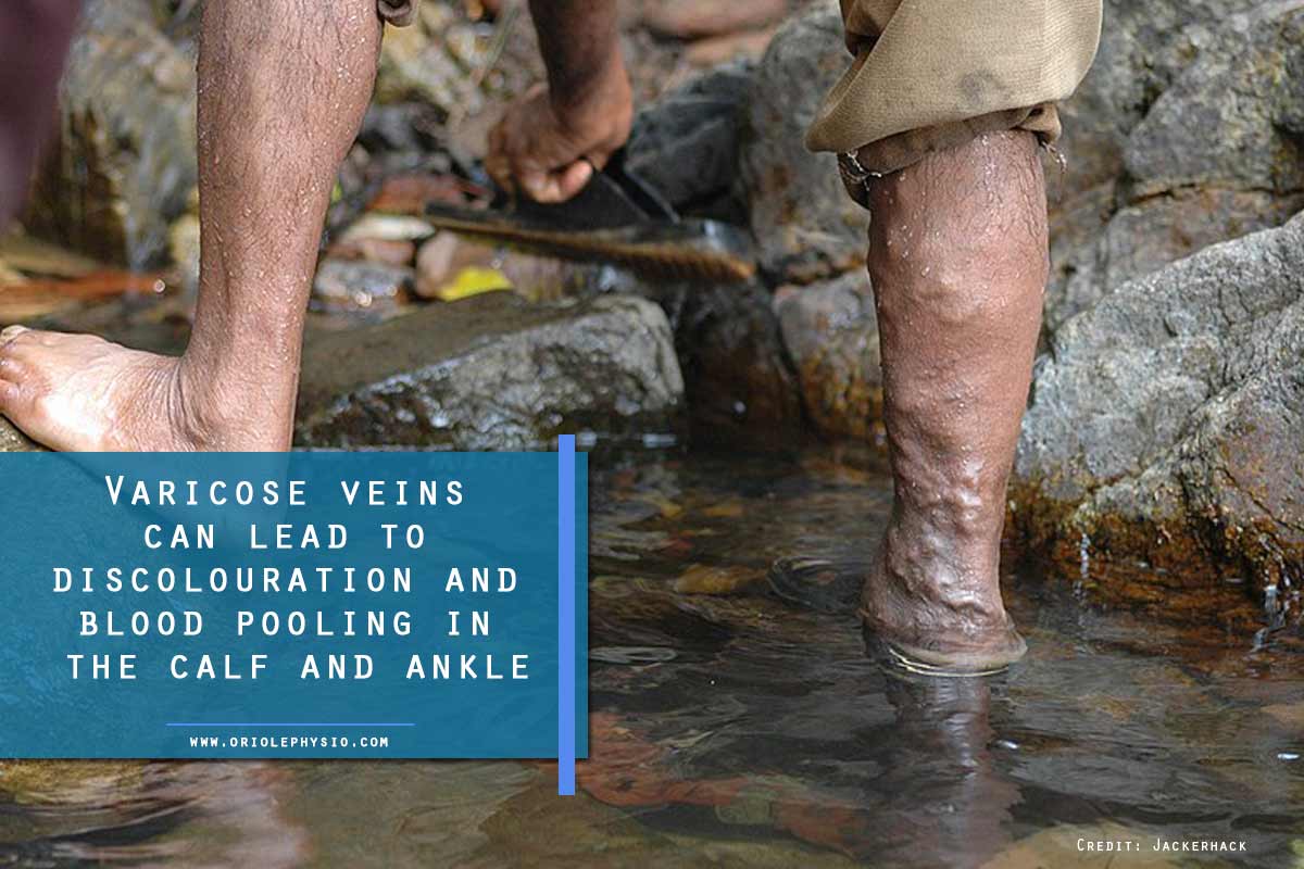 Varicose veins can lead to discolouration and blood pooling in the calf and ankle